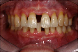 牙周病,牙齒矯正3