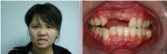 戽斗,斷牙,正顎手術2