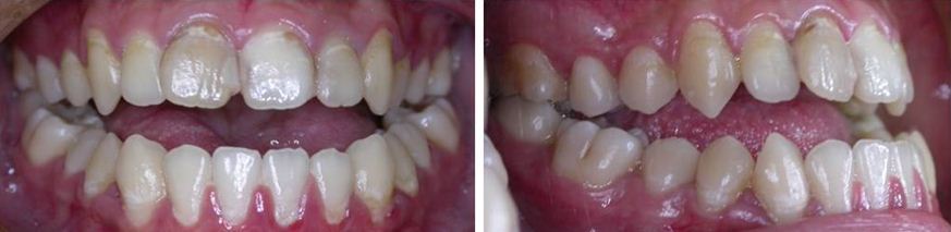 齒顎矯正,牙齒矯正,案例2