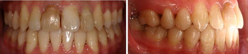 齒顎矯正,牙齒矯正,案例4