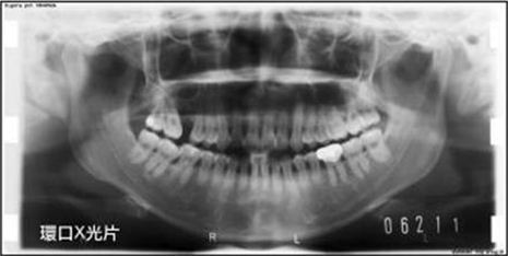 牙齒矯正,治療前檢查8
