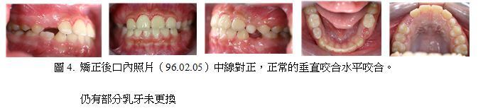 牙齒矯正,案例,前牙4