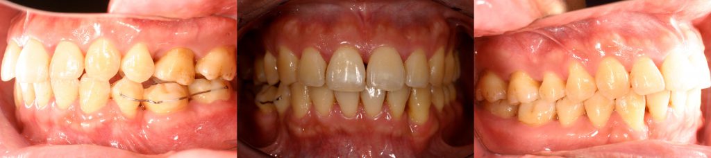 4牙齒矯正,案例,牙齒亂3