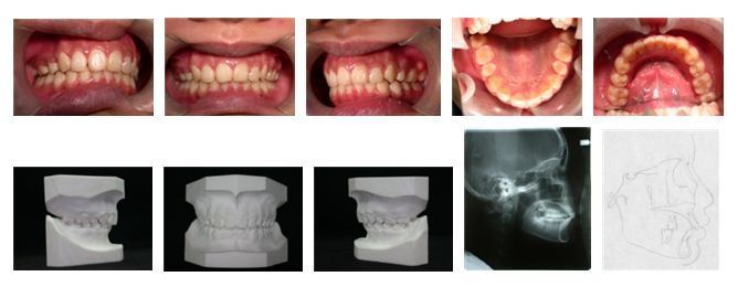 5牙齒矯正,犬齒,案例4