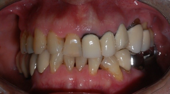 成人植牙矯正,牙齒矯正10