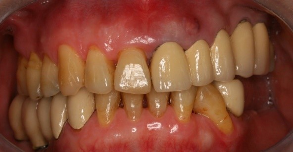 成人植牙矯正,牙齒矯正12