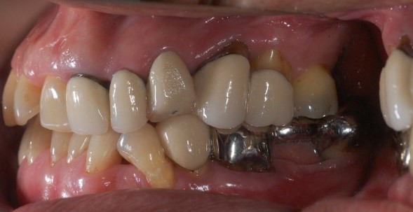 成人植牙矯正,牙齒矯正2