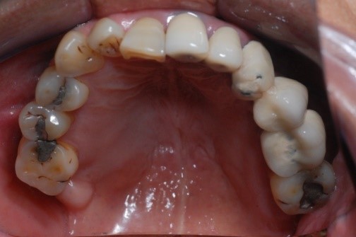 成人植牙矯正,牙齒矯正3