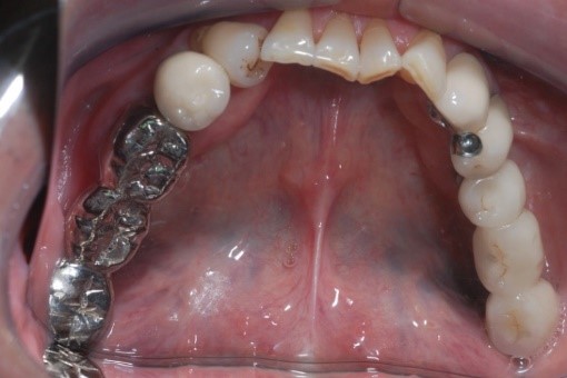 成人植牙矯正,牙齒矯正4