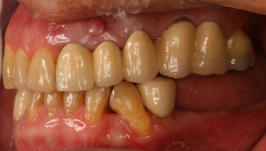 成人植牙矯正,牙齒矯正6
