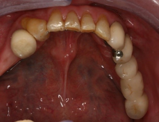 成人植牙矯正,牙齒矯正8