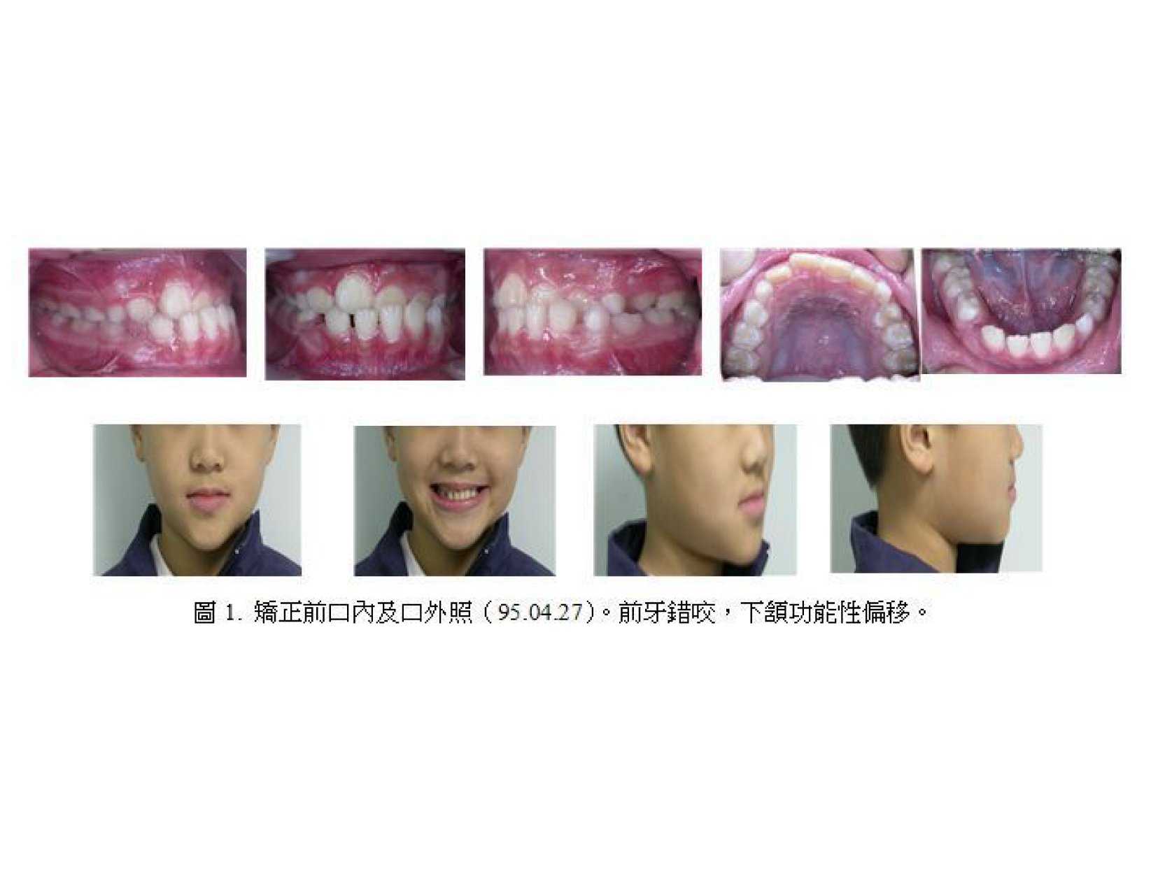 牙齒矯正,案例,前牙-1