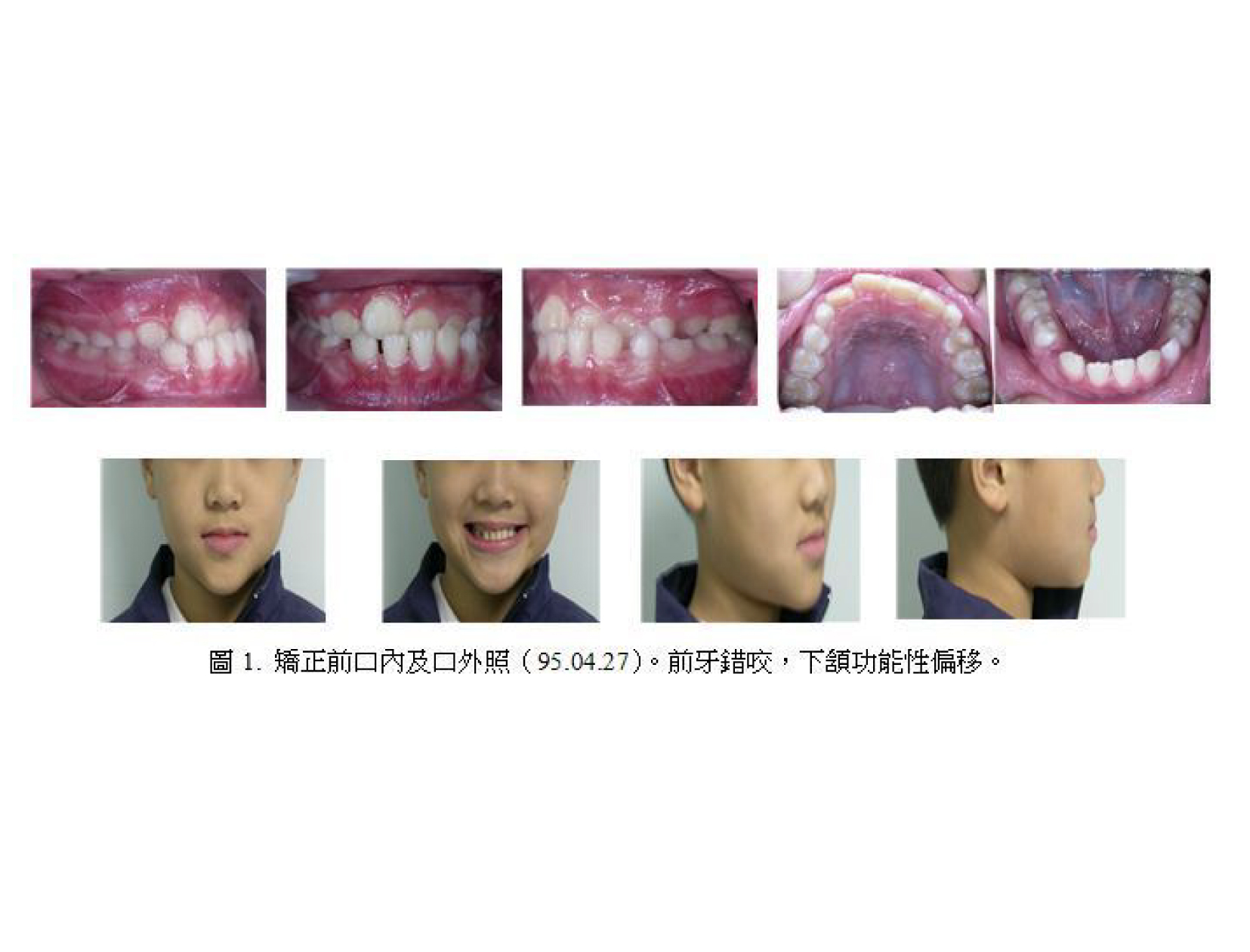 牙齒矯正,案例,前牙-1