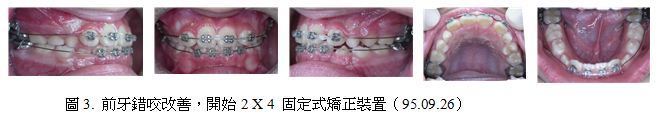 牙齒矯正,案例,前牙3