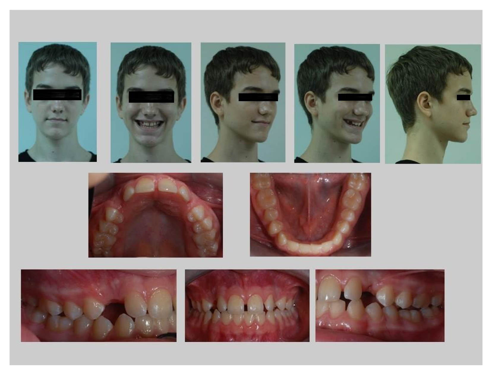 牙齒矯正案例,埋伏齒-1
