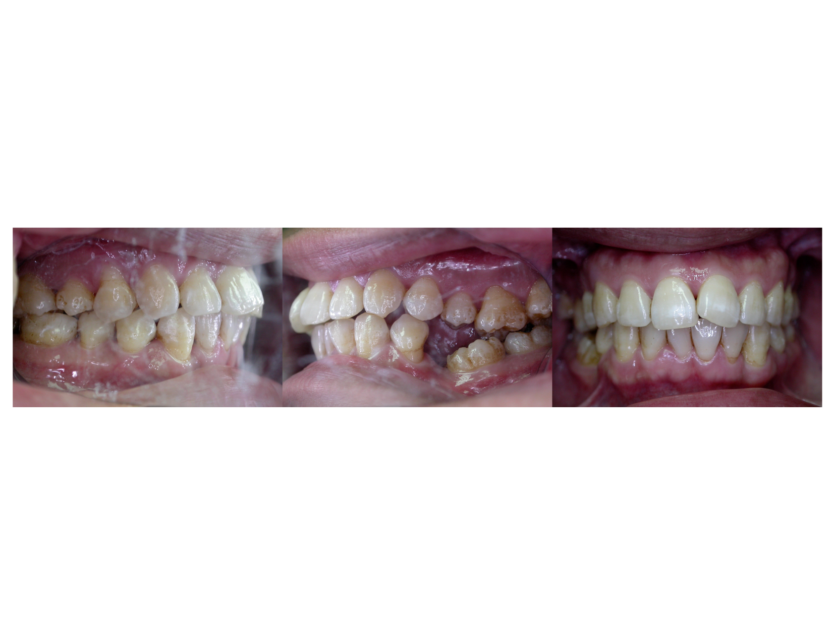 牙齒矯正,案例,牙齒亂-1