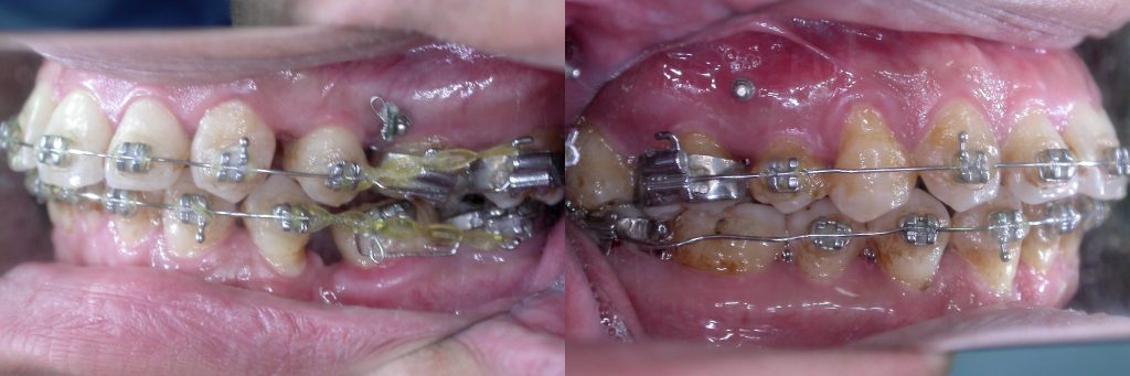 牙齒矯正,案例,牙齒亂3
