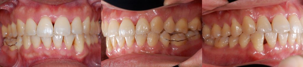 牙齒矯正,案例,牙齒亂6