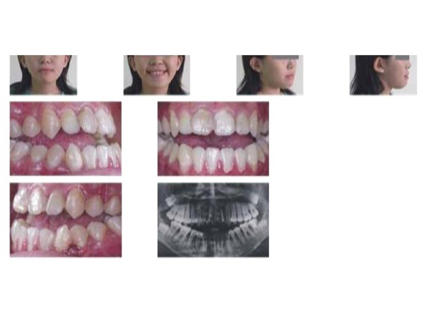 牙齒矯正,正顎手術,案例-1