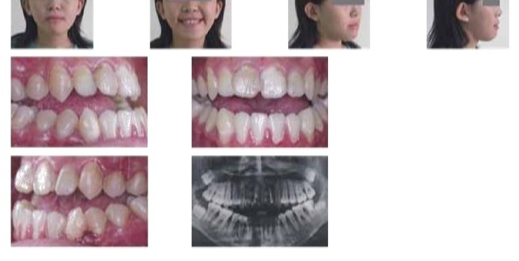 牙齒矯正,正顎手術,案例