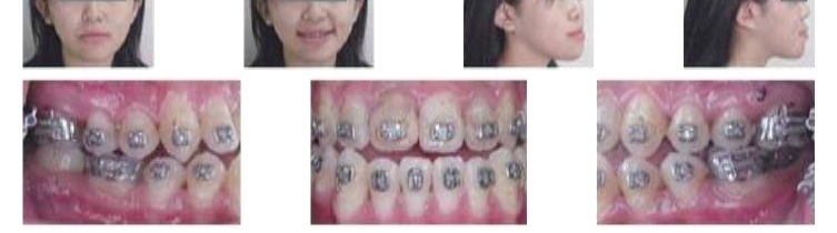 牙齒矯正,正顎手術,案例2