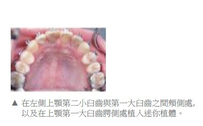 牙齒矯正,正顎手術,案例3
