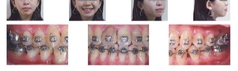 牙齒矯正,正顎手術,案例4