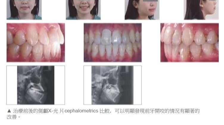 牙齒矯正,正顎手術,案例5