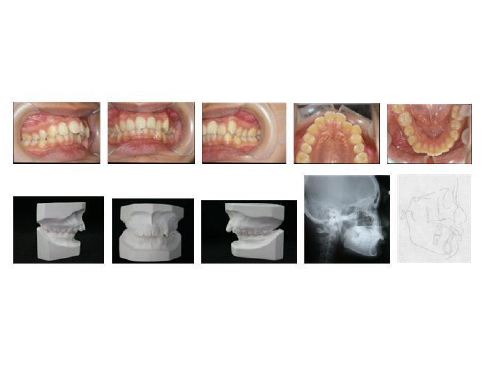 牙齒矯正,犬齒,案例-1