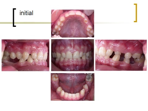 牙齒矯正,跨科治療,案例