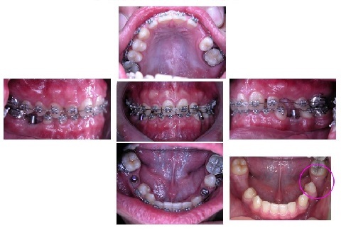 牙齒矯正,跨科治療,案例2