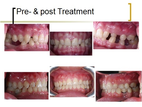 牙齒矯正,跨科治療,案例4