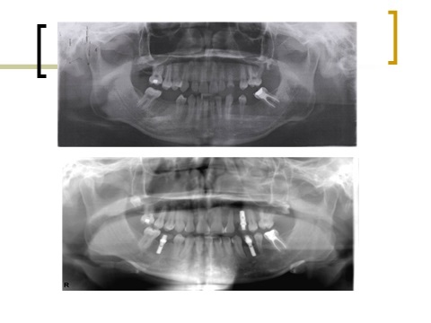牙齒矯正,跨科治療,案例5