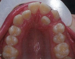 牙齒矯正 齒列凌亂 牙亂