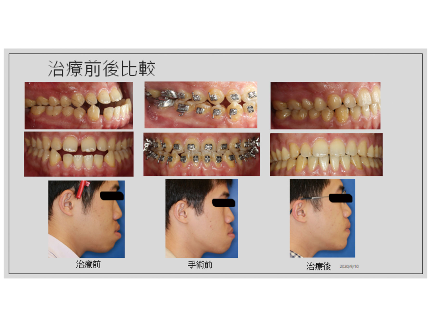 20200917下顎枝垂直截骨手術