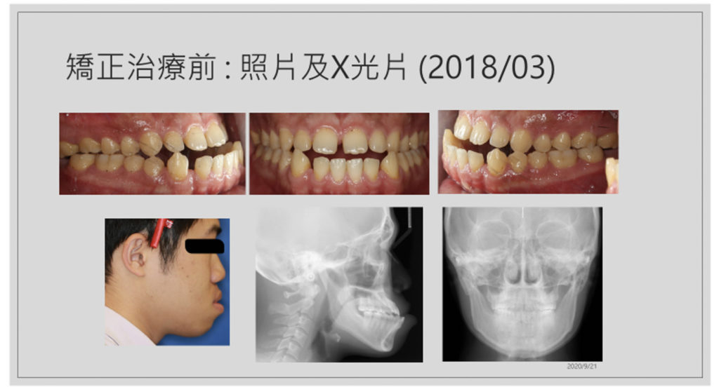 20200917戽斗歪臉合併開咬2