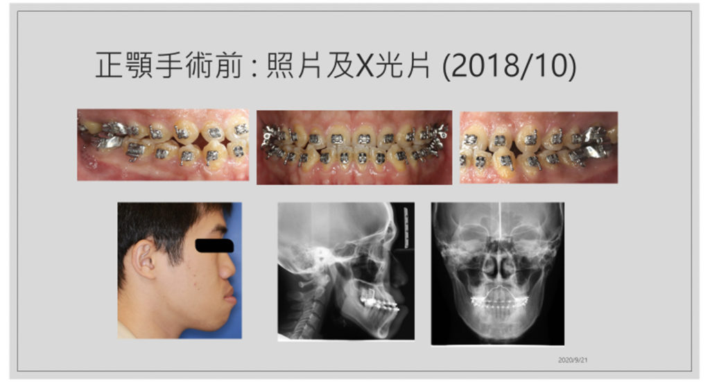 20200917戽斗歪臉合併開咬3