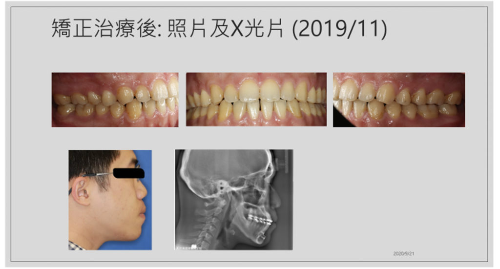 20200917戽斗歪臉合併開咬6