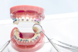 矯正小學堂 1 Regain Your Smile and Confidence
